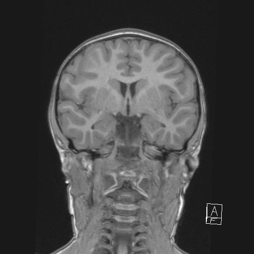 File:Cerebellar stroke (Radiopaedia 32202-33150 Coronal T1 28).png