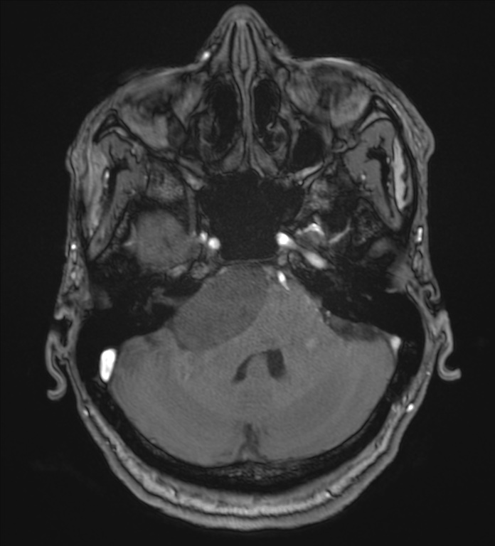 Cerebellopontine angle meningioma (Radiopaedia 72983-83680 Axial MRA 26).jpg