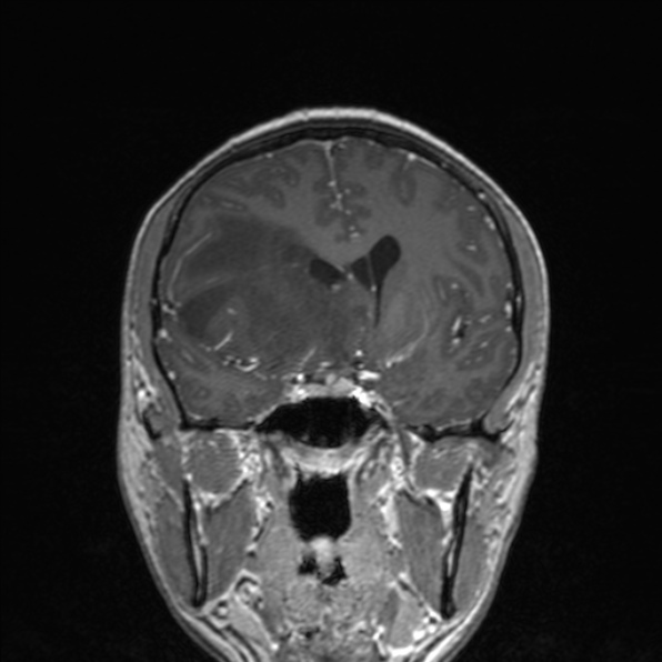 Cerebral abscess (Radiopaedia 24212-24478 Coronal T1 C+ 95).jpg