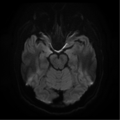 File:Cerebral abscess (Radiopaedia 57774-64740 Axial DWI 10).png