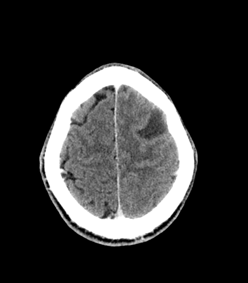 Cerebral abscess (Radiopaedia 57774-64741 Axial C+ delayed 52).png