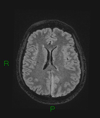 Cerebral abscess and subdural empyema (Radiopaedia 84436-99779 Axial FLAIR 36).jpg