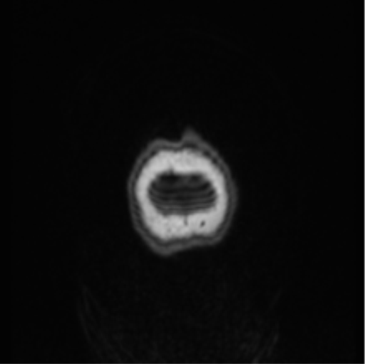 File:Cerebral abscess from pulmonary arteriovenous malformation (Radiopaedia 86275-102291 Coronal T1 3).png