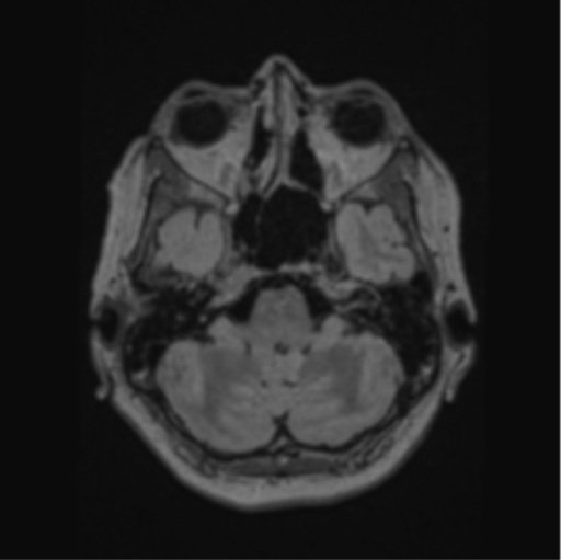 Cerebral abscess from pulmonary arteriovenous malformation (Radiopaedia 86275-102291 J 20).png