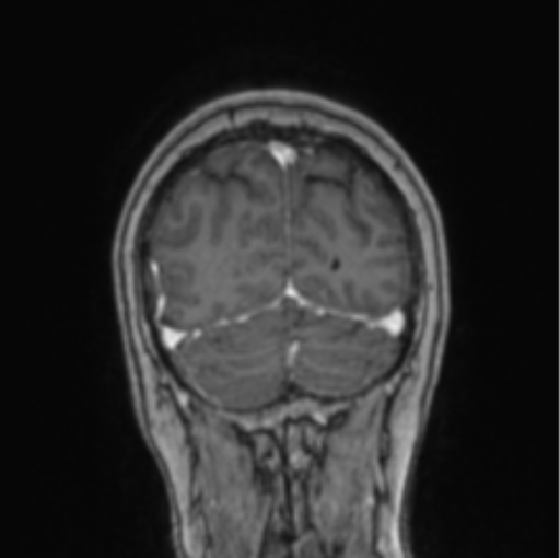 Cerebral abscess from pulmonary arteriovenous malformation (Radiopaedia 86275-102291 L 19).png