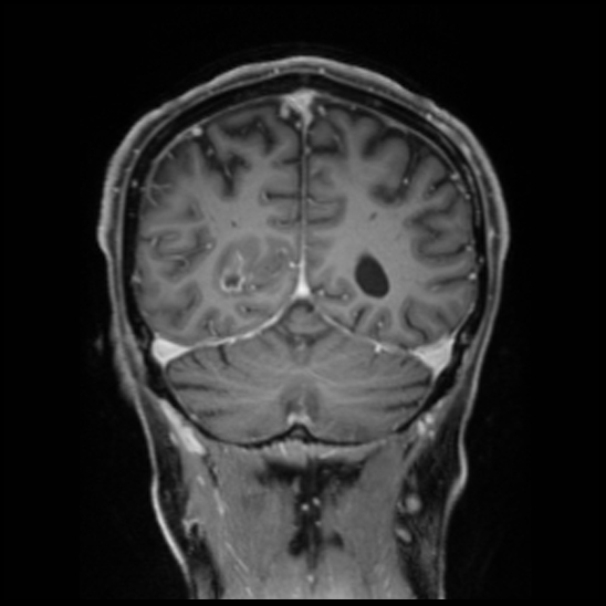 Cerebral abscess with ventriculitis (Radiopaedia 78965-91878 Coronal T1 C+ 48).jpg