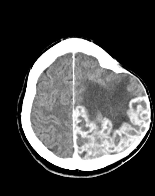 Cerebral abscesses (Radiopaedia 70458-80568 Axial Contrast 48).jpg
