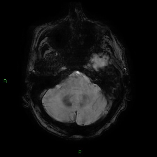 File:Cerebral amyloid angiopathy-associated lobar intracerebral hemorrhage (Radiopaedia 58376-65512 Axial SWI 14).jpg