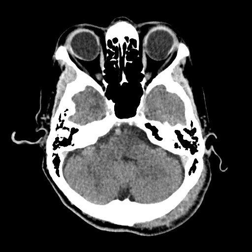 Cerebral amyloid angiopathy-related inflammation (Radiopaedia 74836-85848 Axial non-contrast 17).jpg
