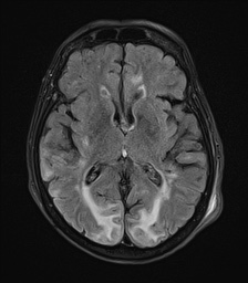 File:Cerebral amyloid angiopathy-related inflammation (Radiopaedia 74836-85849 Axial FLAIR 16).jpg