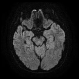 Cerebral amyloid angiopathy (Radiopaedia 28698-28978 Axial DWI 11).jpg