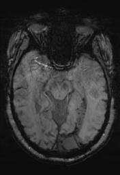 File:Cerebral amyloid angiopathy (Radiopaedia 29129-29518 Axial SWI MPR 14).jpg