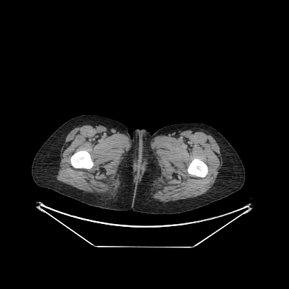 Cerebral and abdominal tuberculosis (Radiopaedia 90499-107853 A 252).jpg