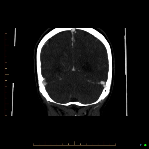Cerebral arteriovenous malformation (AVM) (Radiopaedia 78162-90706 Coronal CTA 29).jpg