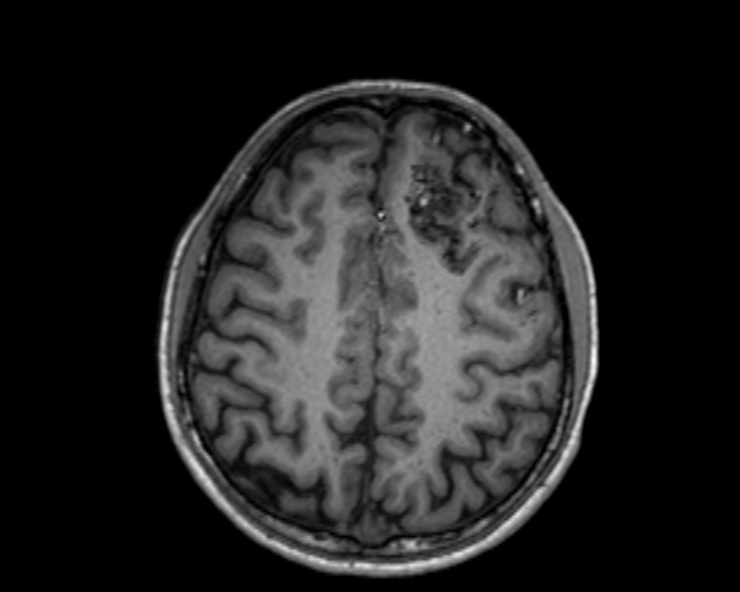 Cerebral arteriovenous malformation (Radiopaedia 30198-30813 Axial T1 23).jpg