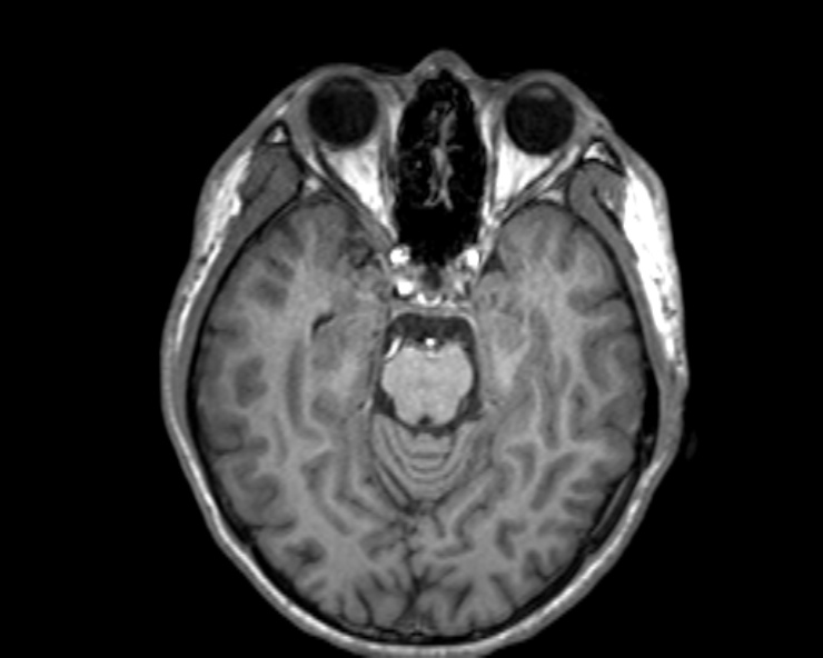 Cerebral arteriovenous malformation (Radiopaedia 30198-30813 Axial T1 39).jpg