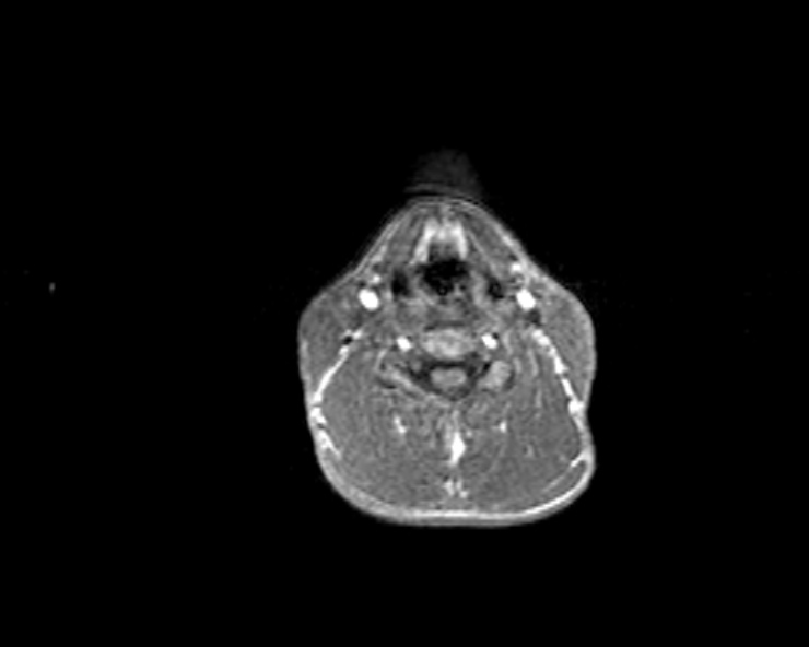 Cerebral arteriovenous malformation (Radiopaedia 30198-30813 Axial T1 71).jpg
