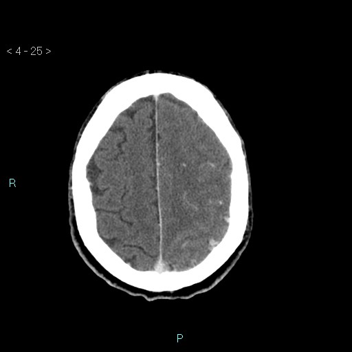 File:Cerebral arteriovenous malformation (Radiopaedia 40528-43125 Axial C+ delayed 25).jpg