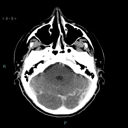 File:Cerebral arteriovenous malformation (Radiopaedia 40528-43125 Axial C+ delayed 9).jpg