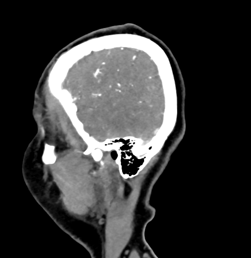 Cerebral arteriovenous malformation (Radiopaedia 73830-84645 D 80).jpg