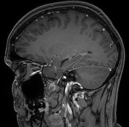 Cerebral arteriovenous malformation (Radiopaedia 74411-85654 Sagittal T1 C+ 42).jpg