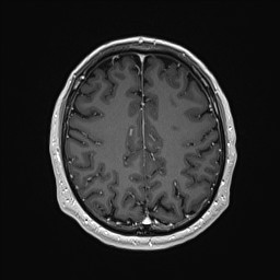 Cerebral arteriovenous malformation (Radiopaedia 84015-99245 Axial T1 C+ 113).jpg