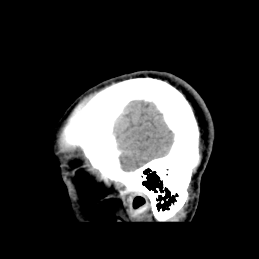 Cerebral arteriovenous malformation (Spetzler-Martin grade 2) (Radiopaedia 41262-44076 A 54).png