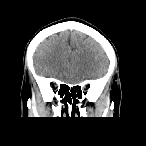 Cerebral arteriovenous malformation (Spetzler-Martin grade 2) (Radiopaedia 41262-44076 Coronal non-contrast 17).png