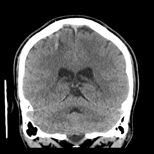 Cerebral arteriovenous malformation (Spetzler-Martin grade 2) (Radiopaedia 41262-44076 Coronal non-contrast 42).png