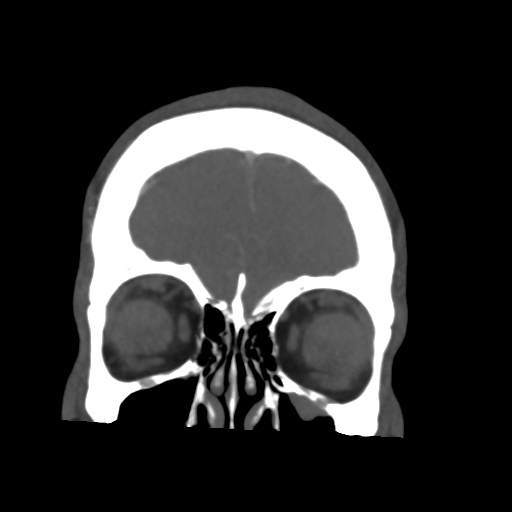 File:Cerebral arteriovenous malformation (Spetzler-Martin grade 2) (Radiopaedia 41262-44076 F 10).png