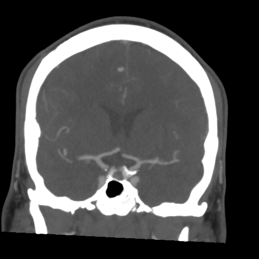 Cerebral arteriovenous malformation (Spetzler-Martin grade 2) (Radiopaedia 41262-44076 F 27).png