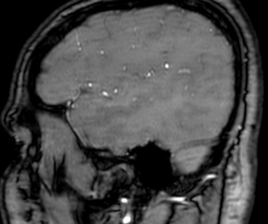 Cerebral arteriovenous malformation at posterior body of corpus callosum (Radiopaedia 74111-84925 J 50).jpg