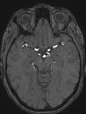 Cerebral arteriovenous malformation with hemorrhage (Radiopaedia 34422-35737 Axial MRA 33).png