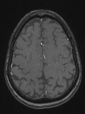 Cerebral arteriovenous malformation with hemorrhage (Radiopaedia 34422-35737 Axial MRA 66).png