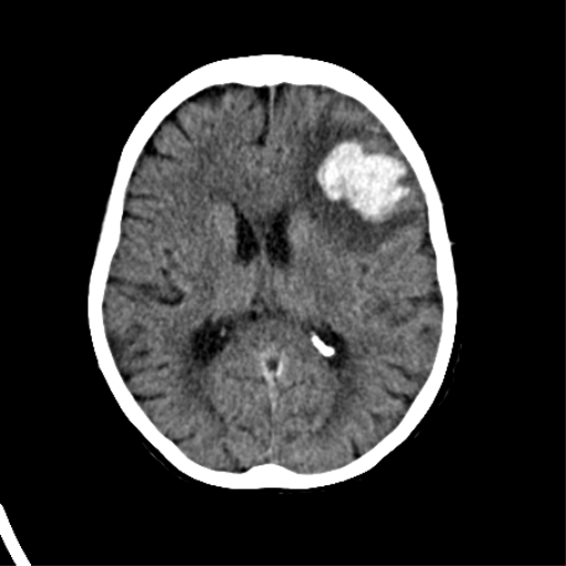 File:Cerebral arteriovenous malformation with lobar hemorrhage (Radiopaedia 44725-48510 Axial non-contrast 24).png