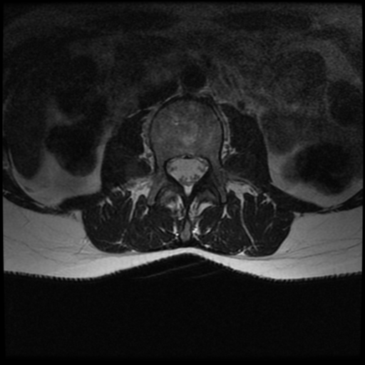 File:Cerebral autosomal dominant arteriopathy with subcortical infarcts and leukoencephalopathy (CADASIL) (Radiopaedia 41018-43763 AX T2 T11-S1 23).png