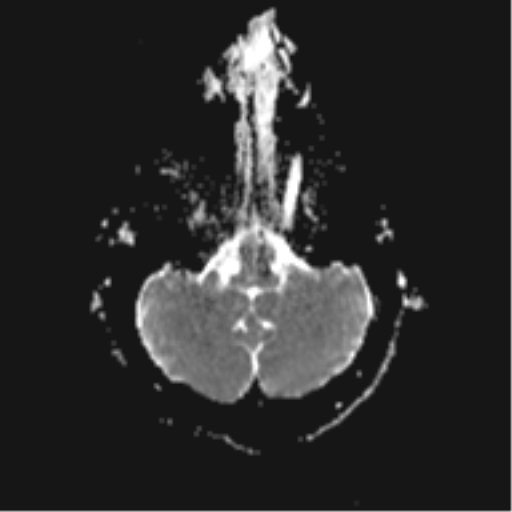 File:Cerebral cavernoma and development venous anomaly (Radiopaedia 37603-39482 Axial ADC 5).png