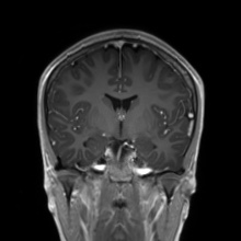 Cerebral cavernous venous malformation (Radiopaedia 70008-80021 Coronal T1 C+ 34).jpg