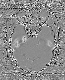 Cerebral cavernous venous malformation (Radiopaedia 70008-80021 G 24).jpg
