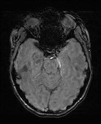 File:Cerebral cavernous venous malformation (Radiopaedia 70008-80021 I 26).jpg
