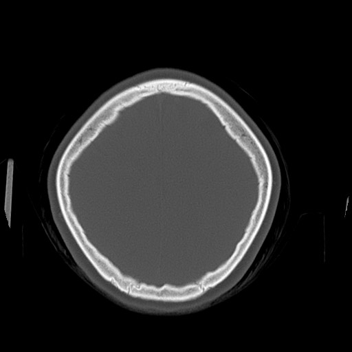 Cerebral cavernous venous malformation (Radiopaedia 70008-80022 Axial bone window 43).jpg