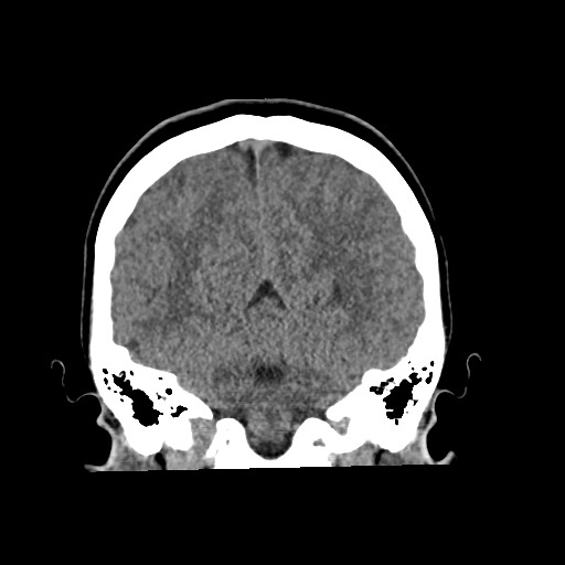 Cerebral cavernous venous malformation (Radiopaedia 70008-80022 non-contrast 49).jpg