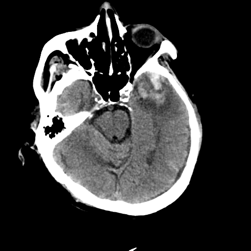 File:Cerebral contusions, subarachnoid hemorrhage and subdural hygromas (Radiopaedia 55399-61830 Axial non-contrast 11).png