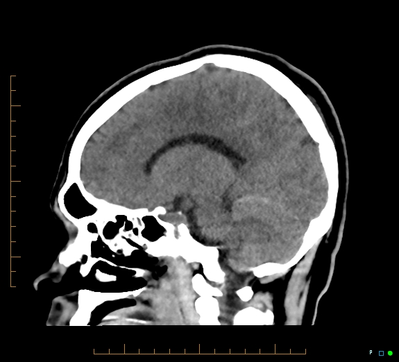 Cerebral fat embolism (Radiopaedia 85521-101220 B 32).jpg