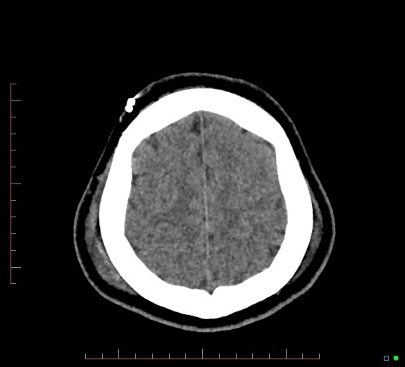 Cerebral fat embolism (Radiopaedia 85521-101224 Axial non-contrast 43).jpg