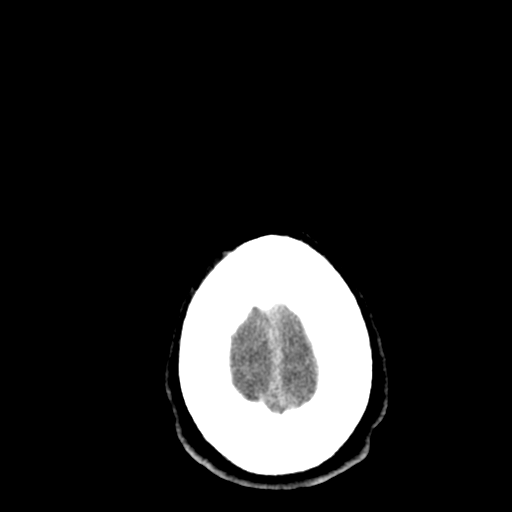 File:Cerebral hemorrhagic contusions- temporal evolution (Radiopaedia 40224-42753 Axial non-contrast 32).png