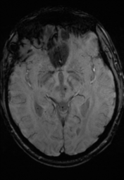 File:Cerebral hemorrhagic contusions- temporal evolution (Radiopaedia 40224-42757 D 17).png