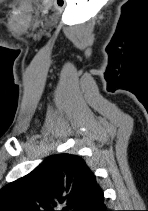 Cerebral hemorrhagic contusions and cervical spine fractures (Radiopaedia 32865-33841 G 19).jpg