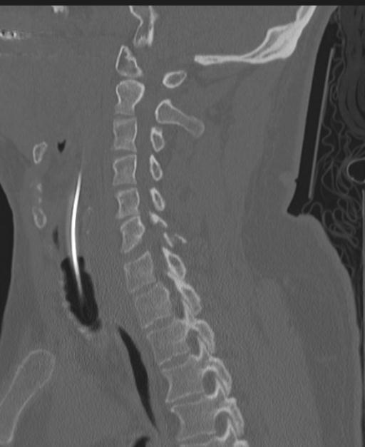 Cerebral hemorrhagic contusions and cervical spine fractures (Radiopaedia 32865-33841 Sagittal bone window 45).jpg