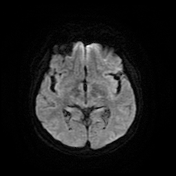 Cerebral metastases - melanoma (Radiopaedia 80972-94522 Axial DWI 15).jpg